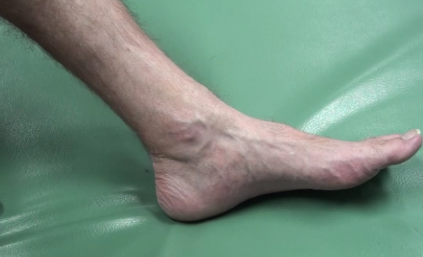 Veins in the Foot